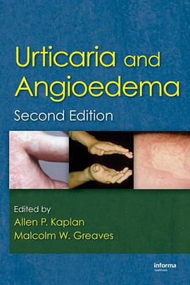 Urticaria and Angioedema pdf epub mobi 下载