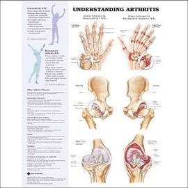 Understanding Arthritis Anatomical Chart