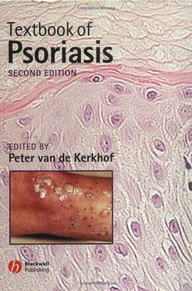 Textbook of Psoriasis