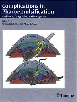 Complications in Phacoemulsification pdf epub mobi 电子书 下载