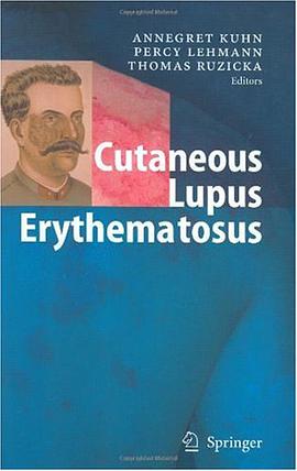 Cutaneous Lupus Erythematosus