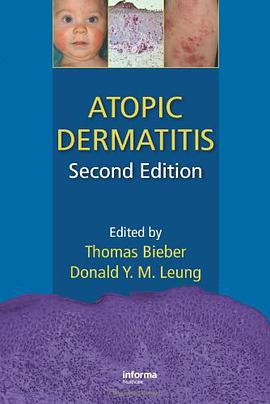 Atopic Dermatitis pdf epub mobi 电子书 下载