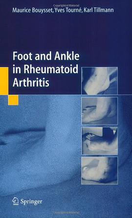 Foot and Ankle in Rheumatoid Arthritis
