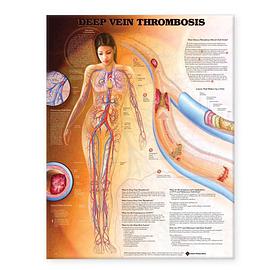 Deep Vein Thrombosis Anatomical Chart pdf epub mobi 电子书 下载
