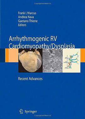 Arrhythmogenicrv Cardiomyopathy / Dysplasia pdf epub mobi 电子书 下载