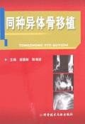 同种异体骨移植
