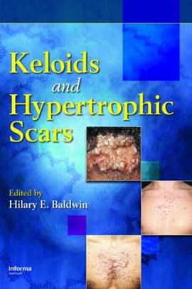 Keloids and Hypertrophic Scars pdf epub mobi 电子书 下载