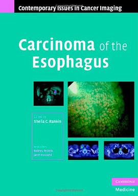 Carcinoma of the Esophagus